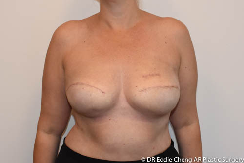 breast reconstruction brisbane Dr Eddie Cheng