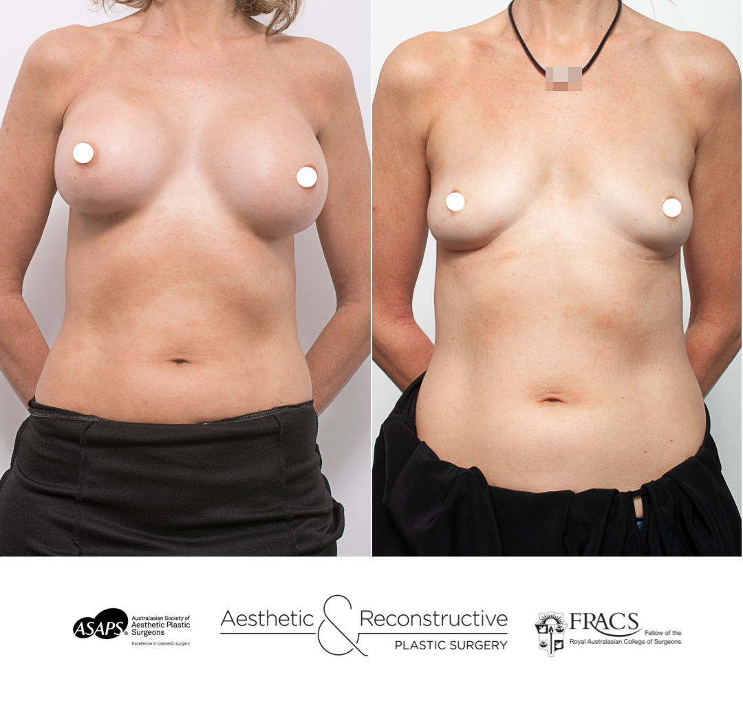 Explant Surgery or breast implant removal surgery by Dr Eddie Cheng Brisbane