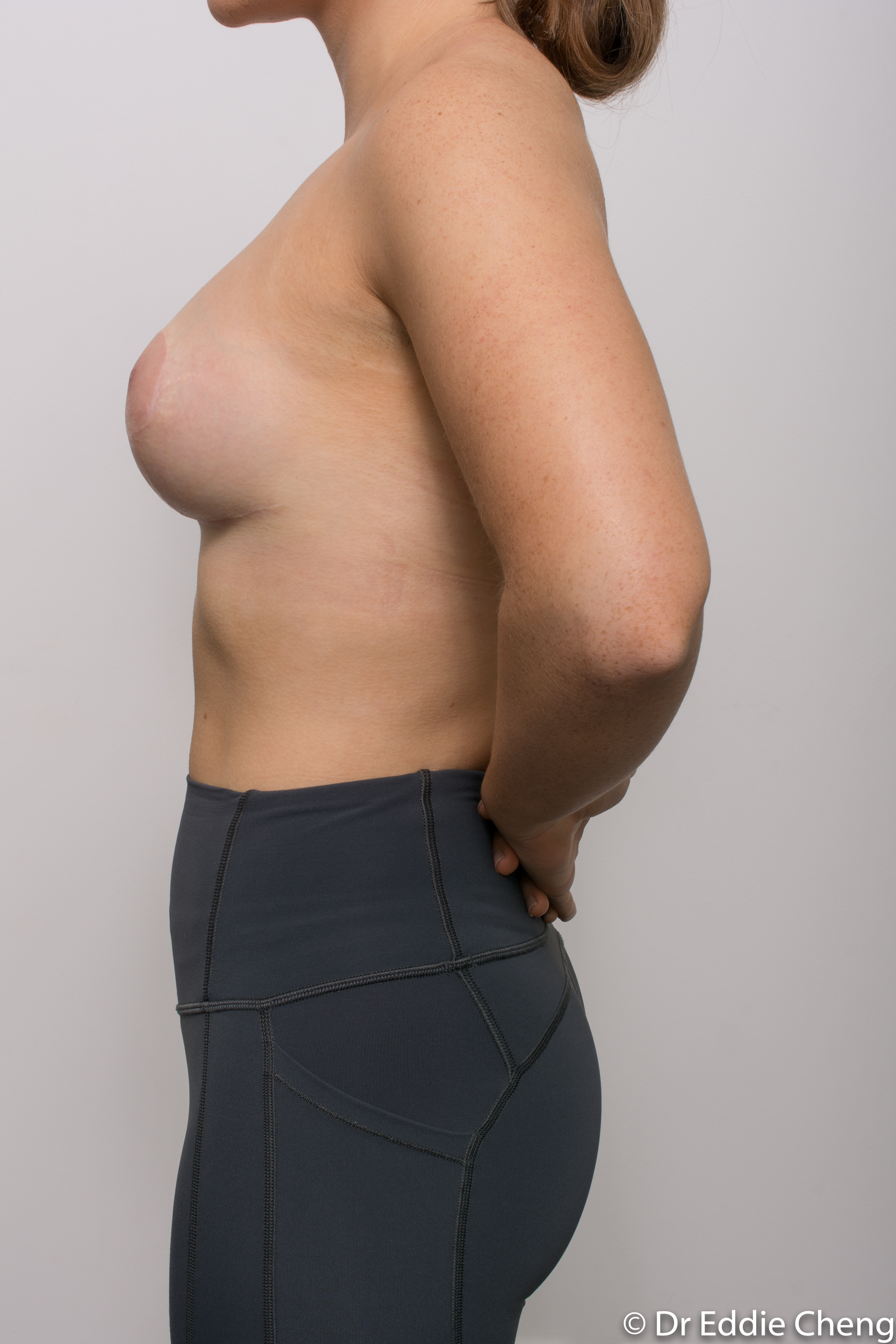 2 stage procedure tuberous breasts dr eddie cheng brisbane surgeon pre and post operative images -3-2