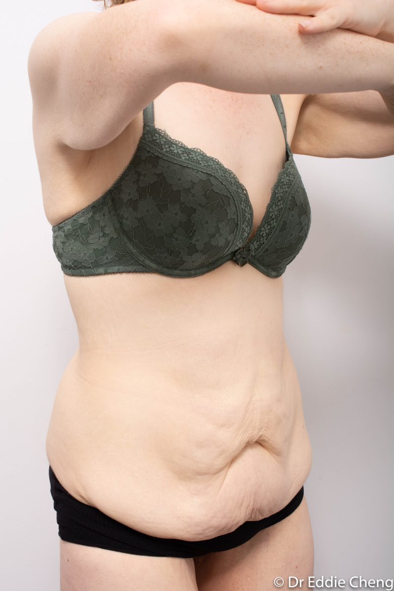 Abdominoplasty