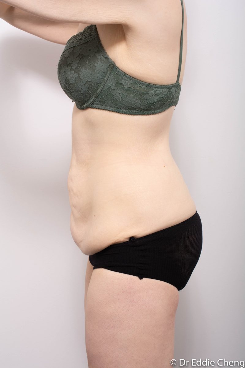 312-post-abdominoplasty-4-800x1200