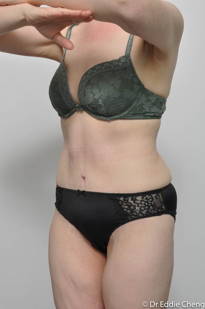 312-post-abdominoplasty-5-800x1204