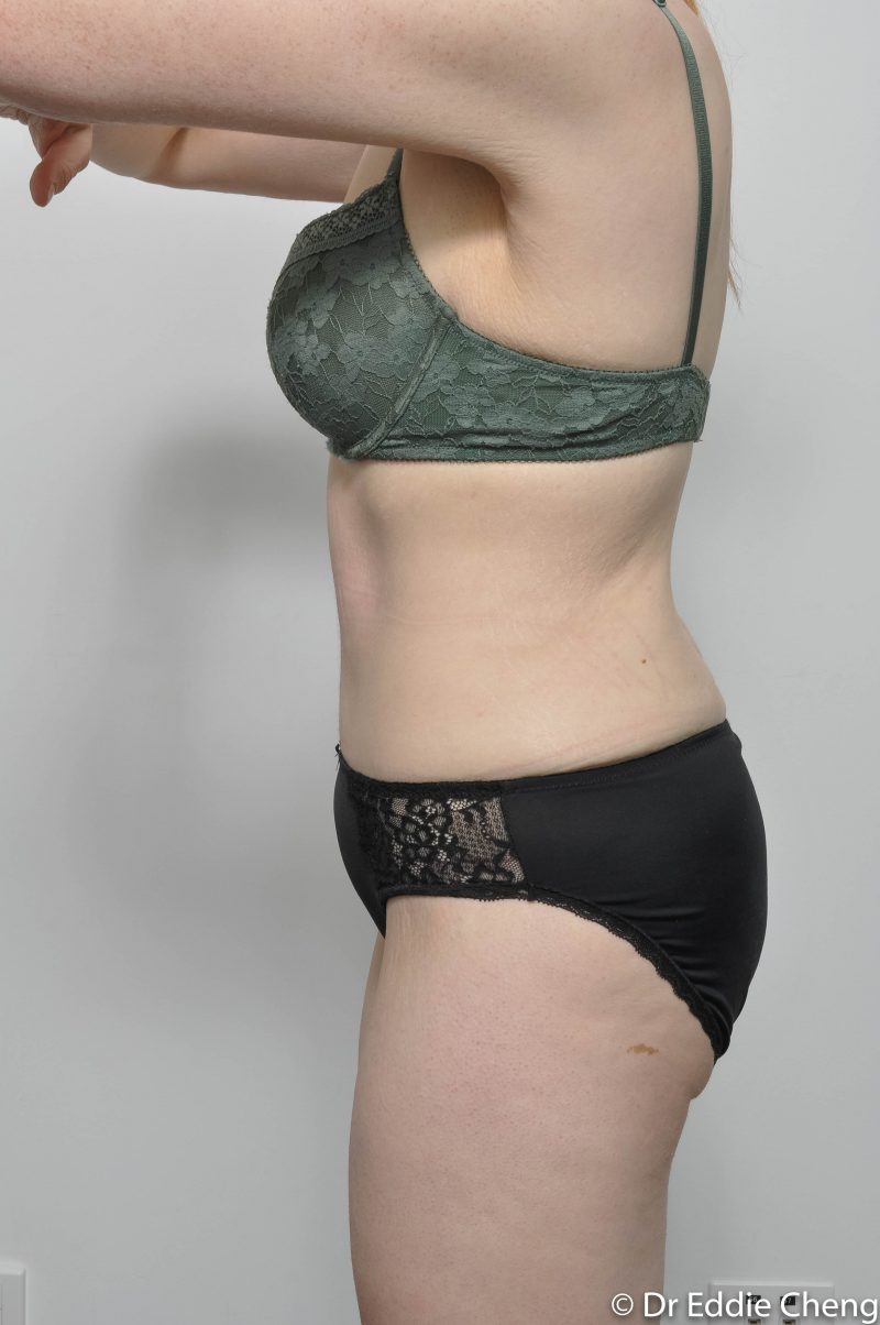 312-post-abdominoplasty-6-800x1204