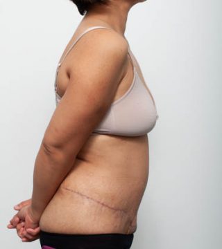 Abdominoplasty