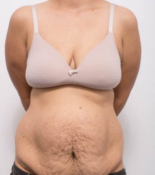 Abdominoplasty