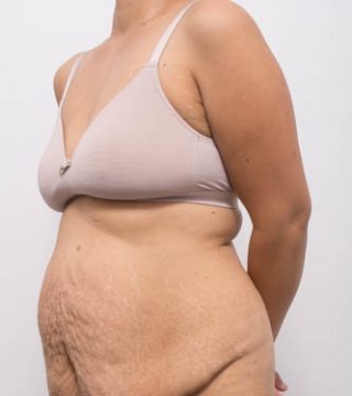 Abdominoplasty