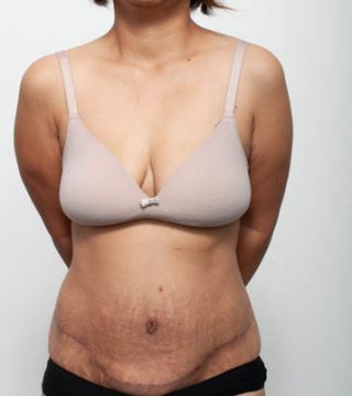 Abdominoplasty