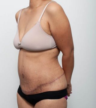 Abdominoplasty