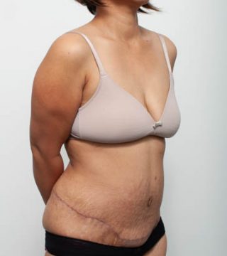 Abdominoplasty