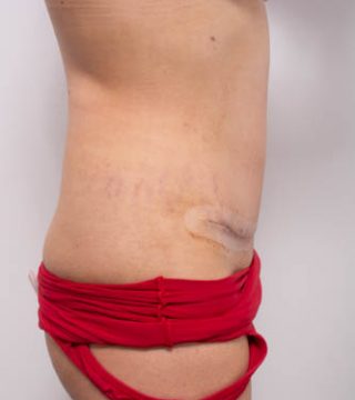 Abdominoplasty