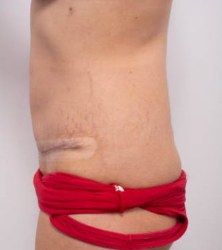 Abdominoplasty