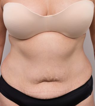 Abdominoplasty