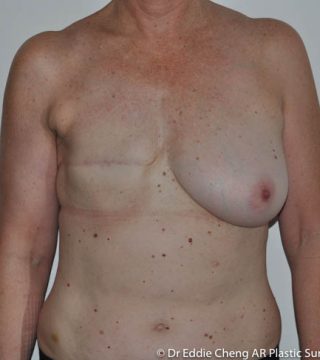 Breast Reconstruction