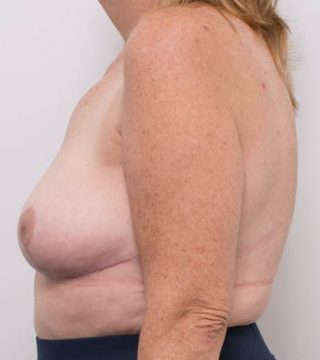 Breast Reduction