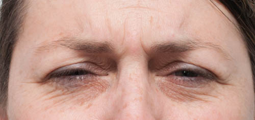 Anti Wrinkle Treatment