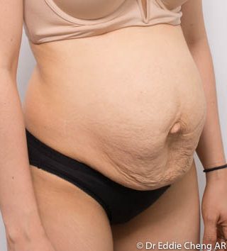 Abdominoplasty