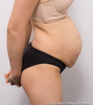 Abdominoplasty