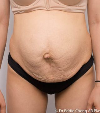 Abdominoplasty