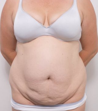 Abdominoplasty