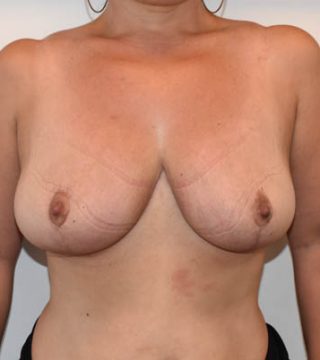 Breast Reduction