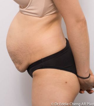 Abdominoplasty