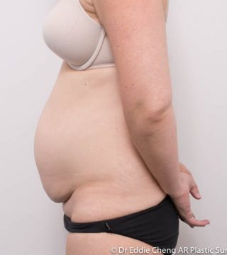 Abdominoplasty