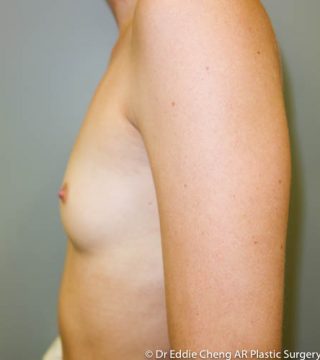 Breast Augmentation