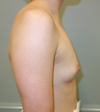 Breast Augmentation