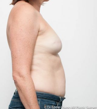 Breast Reconstruction