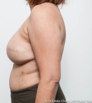 Breast Reconstruction