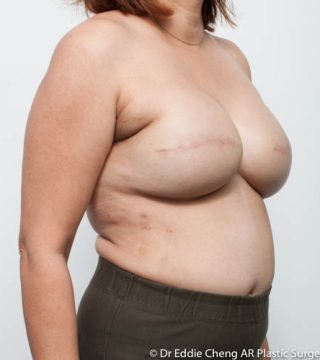 Breast Reconstruction