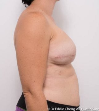 Breast Reconstruction