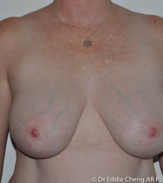 Breast Reduction