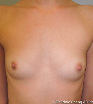 Breast Augmentation