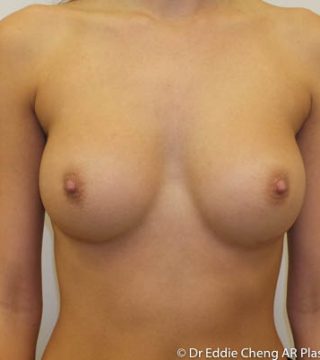 Breast Augmentation