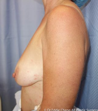 Breast Reconstruction