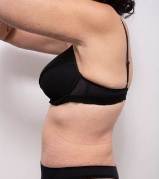 Abdominoplasty