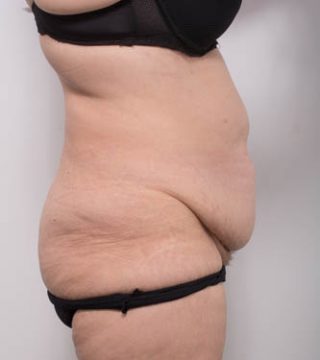 Abdominoplasty