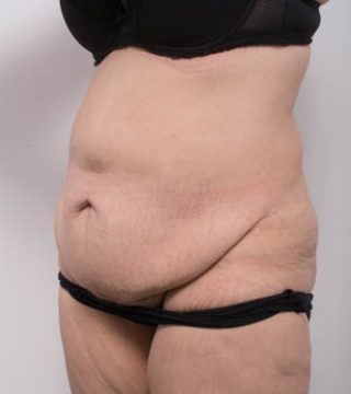 Abdominoplasty