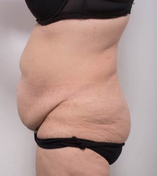 Abdominoplasty