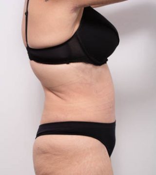 Abdominoplasty