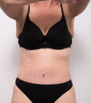 Abdominoplasty