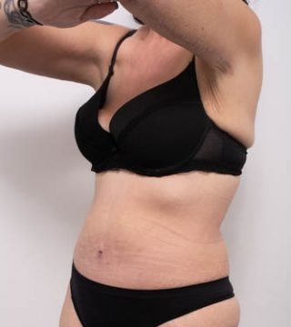 Abdominoplasty