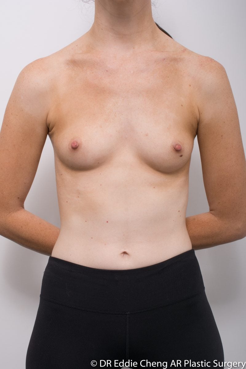 Breast Augmentation