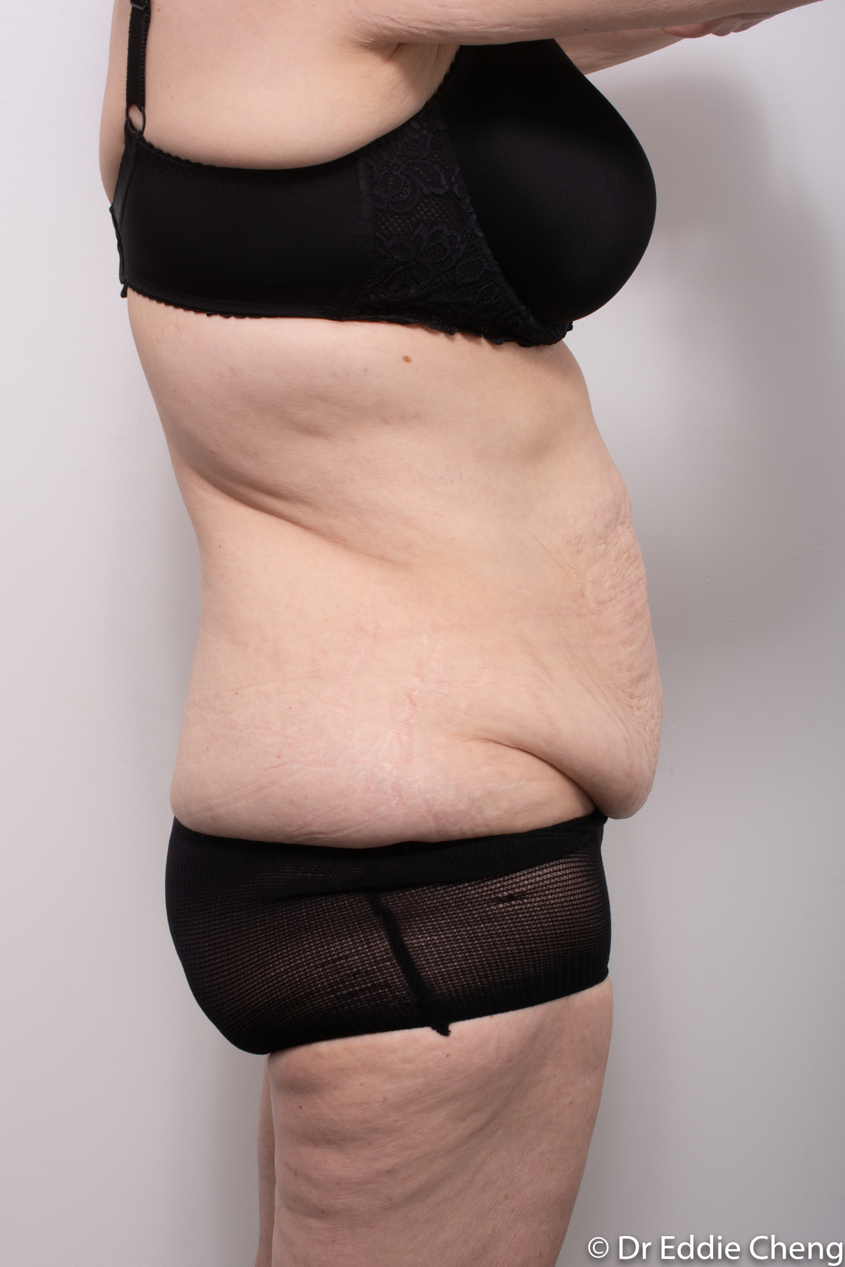 Body lift circumferential dr eddie cheng brisbane surgeon pre and post operative images -1