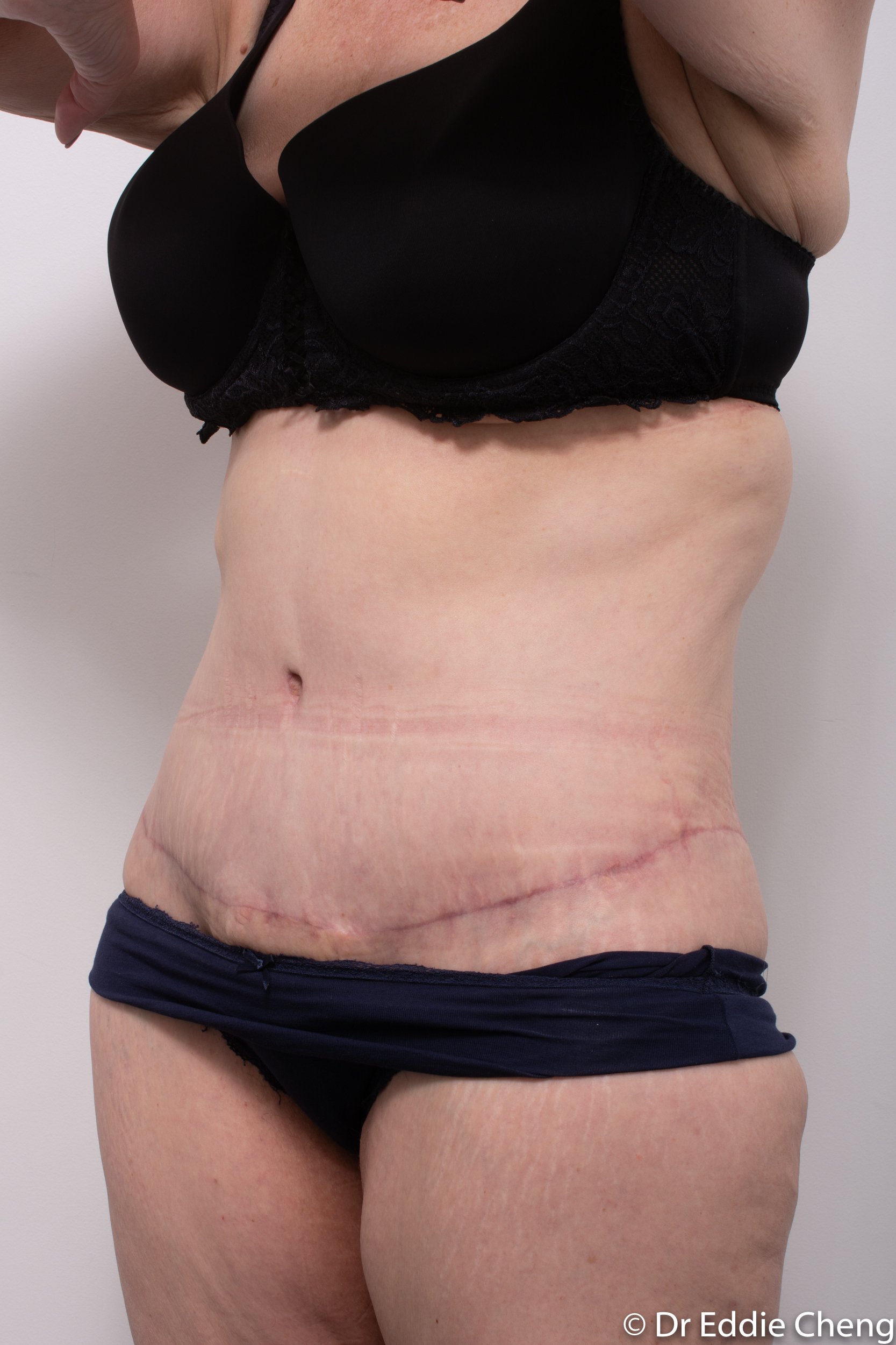 Body lift circumferential dr eddie cheng brisbane surgeon pre and post operative images -2-2