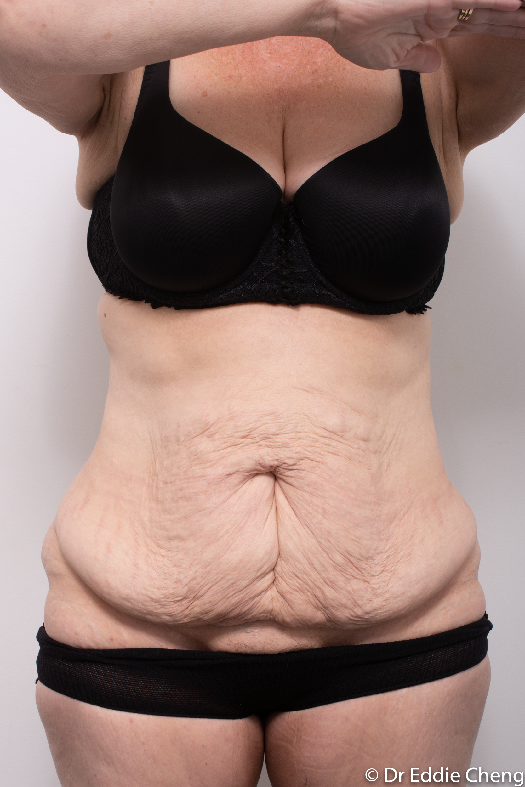 Body lift circumferential dr eddie cheng brisbane surgeon pre and post operative images -3