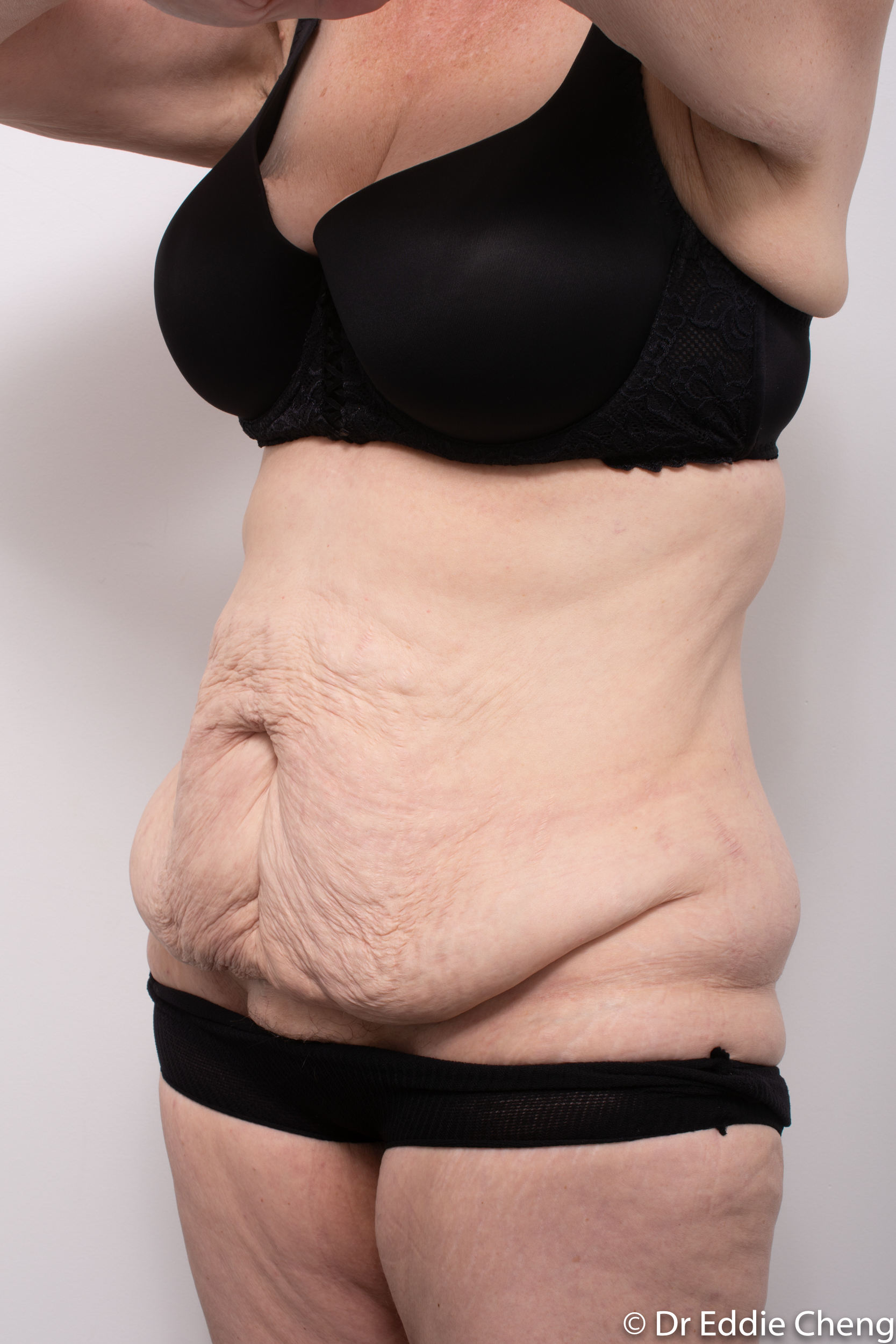 Body lift circumferential dr eddie cheng brisbane surgeon pre and post operative images -4