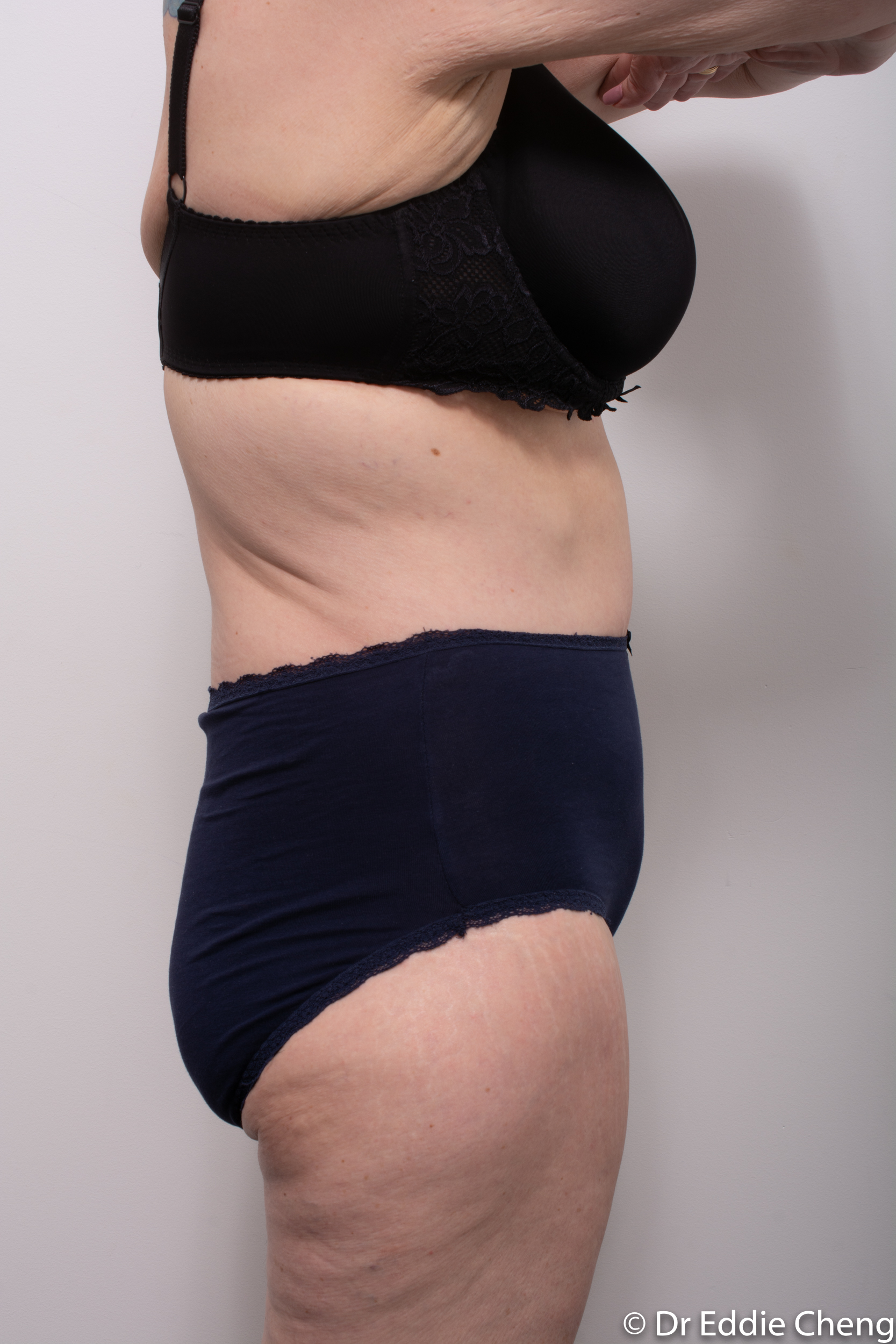 Body lift circumferential dr eddie cheng brisbane surgeon pre and post operative images -8