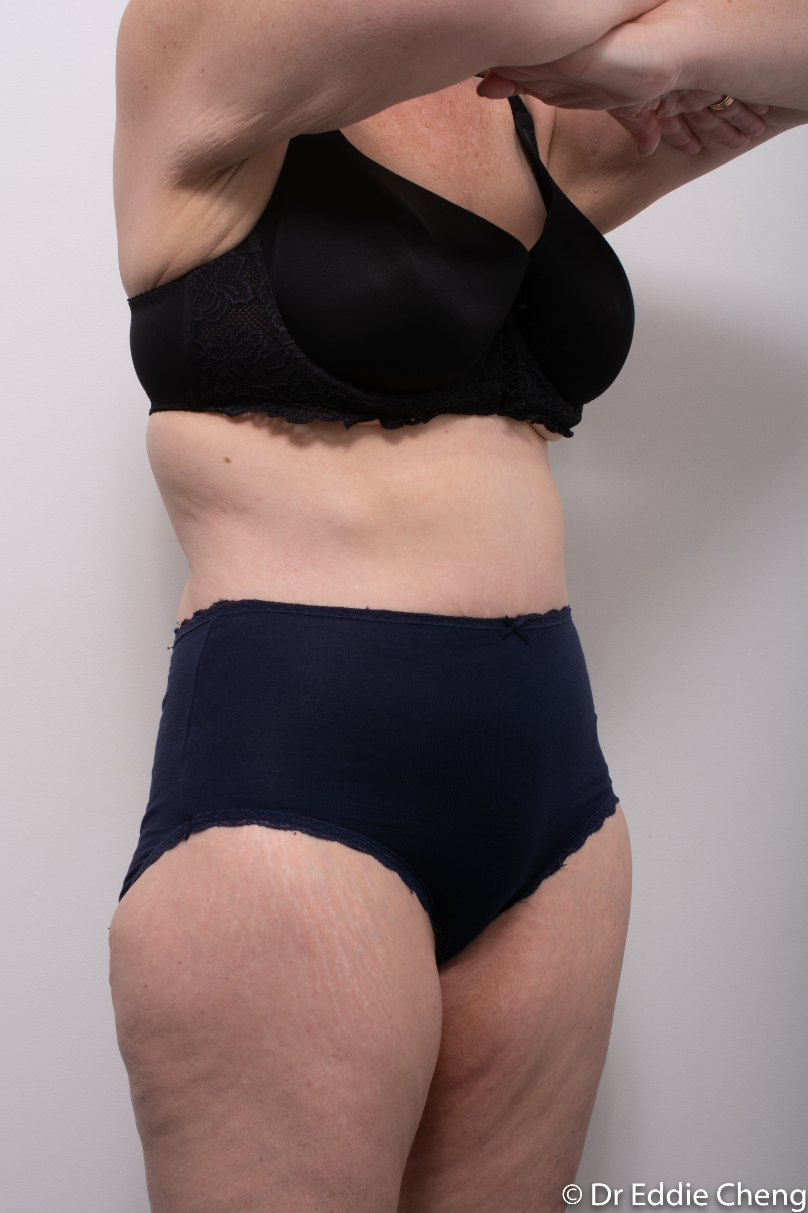 Body lift circumferential dr eddie cheng brisbane surgeon pre and post operative images -9